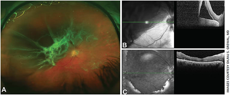 Figure 6. PDR with combined tractional-rhegmatogenous retinal detachment (A and B). Postoperative OCT following vitrectomy surgery shows re-attachment of the macula with restoration of the retinal architecture (C).