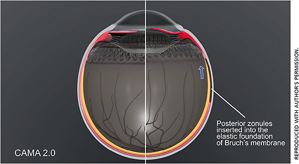 Figure 4. CAMA 2.0 demonstrating the elastic foundation in the choroid in accommodation (right half) and disaccommodation (left half).