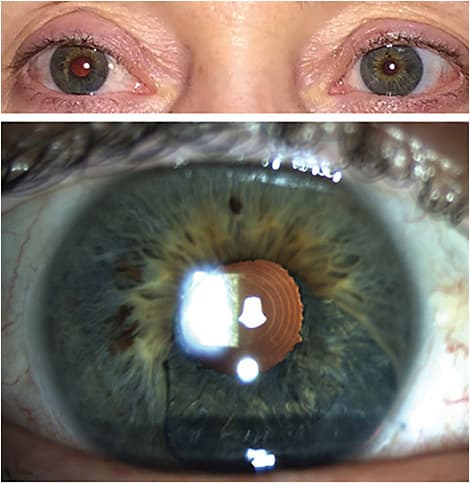 Note the pre-op images (top) with subtotal iris damage and a traumatic cataract with count fingers vision at 2 feet. In the postop images (bottom), the anterior segment has been fully reconstructed with a return of vision to 20/50 (Mx: -0.50+0.50x043), despite the axial corneal scar. There is a marked reduction of transillumination. The capsular tension ring can be seen just outside of the edge of the in-the-bag iris prosthesis in the retroillumination image. Also note the excellent color match to the original iris tissue, restoring a normal body image.