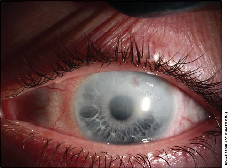 Figure 1. External photograph of patient&#8217;s left eye. Superficial and deep corneal neovascularization was noted. Moderate corneal haze was present superiorly and laterally. There was a ghost vessel extending vertically through the visual axis.