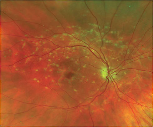 Figure 1. Color fundus photo showing typical yellow-white flecks that extend into the midperiphery of a patient with STGD1.