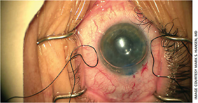 Figure 3. Trifold graft in position, centered and supported by an air bubble.