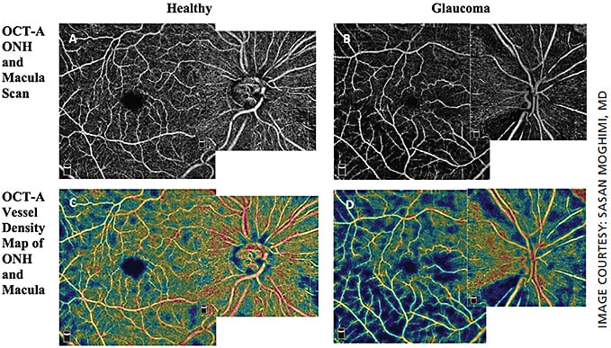 Figure 5. OCT-A scans of ONH (4.5 x 4.5 mm2) and macula (6 x 6 mm2) for healthy subject (A) and glaucoma patient (B) and the corresponding vessel density maps of ONH and macula scans for the same healthy subject (C) and glaucoma patient (D). Note the reduced ONH and macular vessel density in the glaucoma patient when compared to the healthy subject.