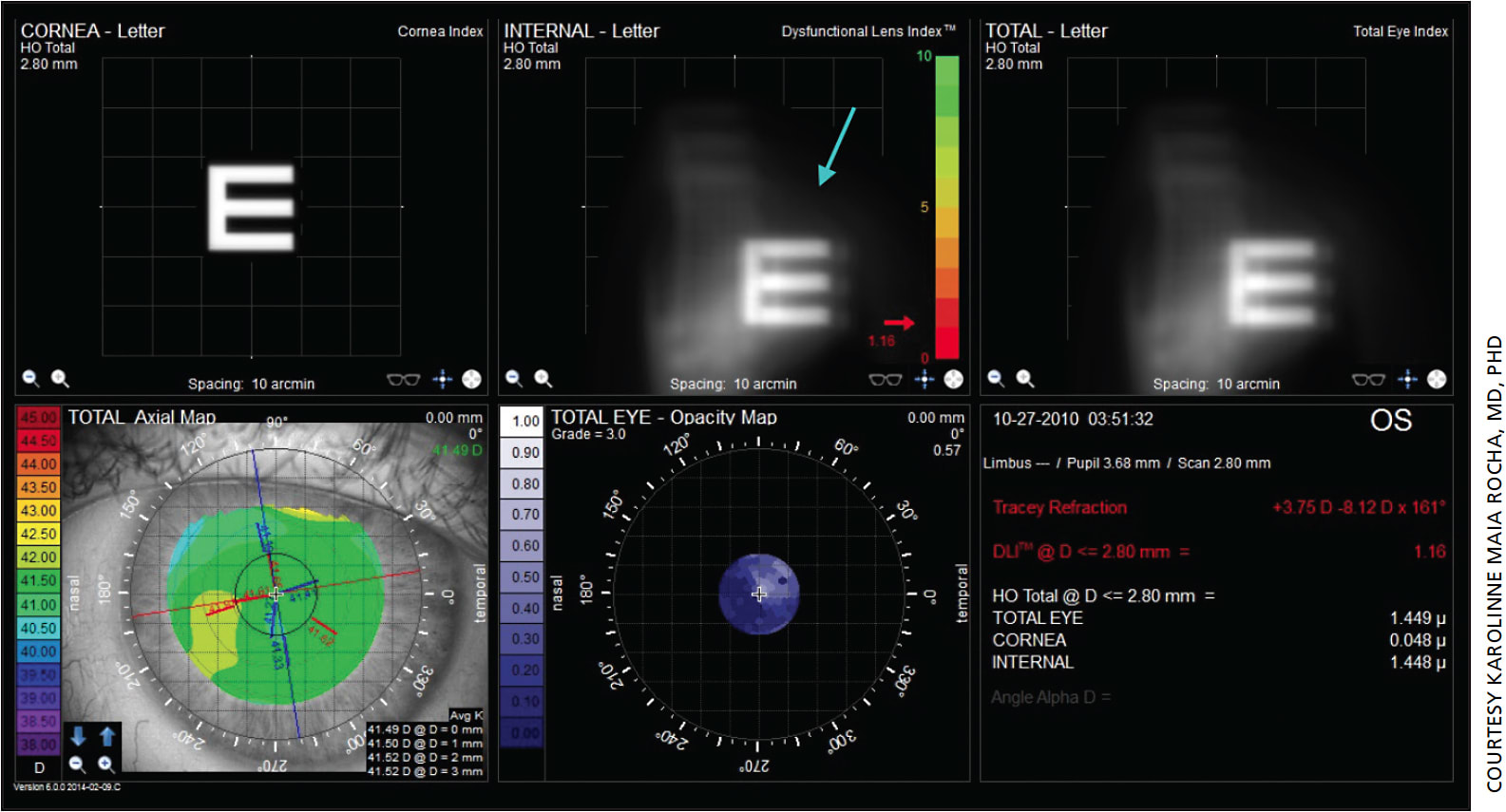 Figure 3. This is the right eye of a 51-year-old hyperopic female patient who presented for LASIK. Her distance vision is still 20/20 but she has stage 2 DLS. As shown in the top middle, her DLI and lenticular aberrations would lead me to recommend a lens-based procedure.