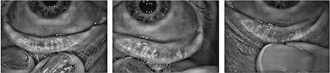 Figure 2. Meibography of the left eye was estimated at grade 2 or 3.