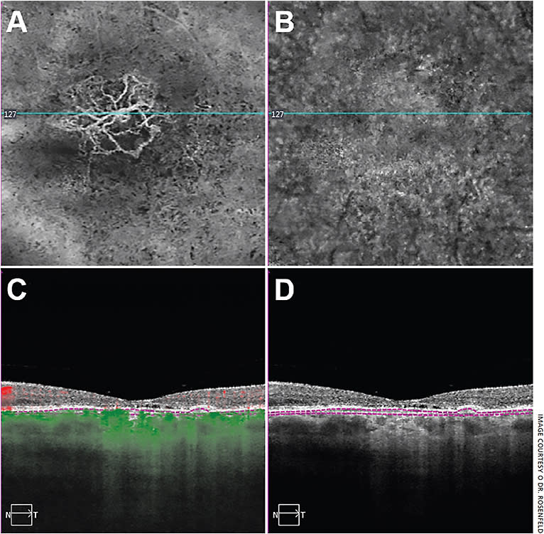 Figure 1. A patient seen with a history of central serous chorioretinopathy and prior treatment with anti-VEGF therapy. On SS-OCT angiographic imaging, a 6 mm × 6 mm raster scan was performed.
A: En face OCT angiographic flow image from a custom subretinal pigment epithelium (RPE) slab showing type 1 macular neovascularization. The boundaries of the sub-RPE slab are shown in panels C and D.
B: En face structural image from the same sub-RPE slab used to image the neovascular flow shown in A.
C: Structural B-scan with superimposed flow derived from the position of the blue line in A and B. Red represents retinal flow, and green represents flow under the RPE. The segmentation lines depict the position of the sub-RPE slab with the inner boundary following the RPE layer and the outer boundary following Bruch’s membrane.
D: Structural B-scan without flow derived from the same sub-RPE slab dimensions depicted in C.
