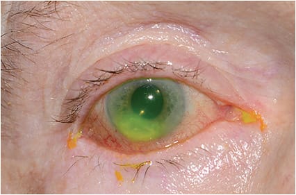 Figure 1: Neurotrophic keratitis with ulceration in the setting of cicatricial ectropion.