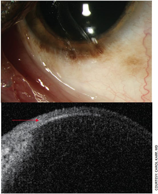 Figure 6. Slit lamp photo and anterior segment OCT of primary acquired melanosis.