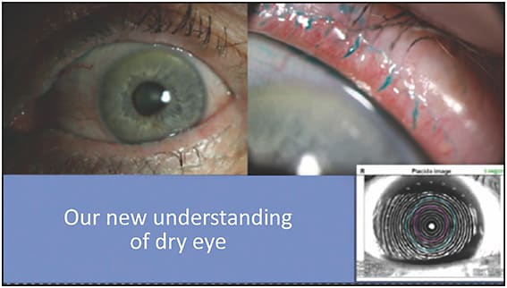 Figure 1. Often, patients referred for cataract surgery dismiss their dry eye symptoms as normal signs of aging.