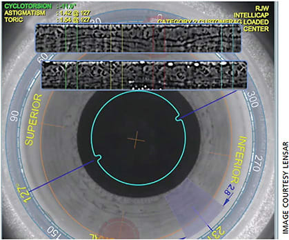 Figure 2. A view of the IntelliAxis capsular marking system. The top ribbons of the preop view are unrolled into a well-defined image to compare to the intraoperative view of the same iris. The system matches them and adjusts for cyclorotation. Note the vertical bars with the matched areas. The system then creates little capsular nubs on the correct axis to assist in placing the toric IOL perfectly on axis.