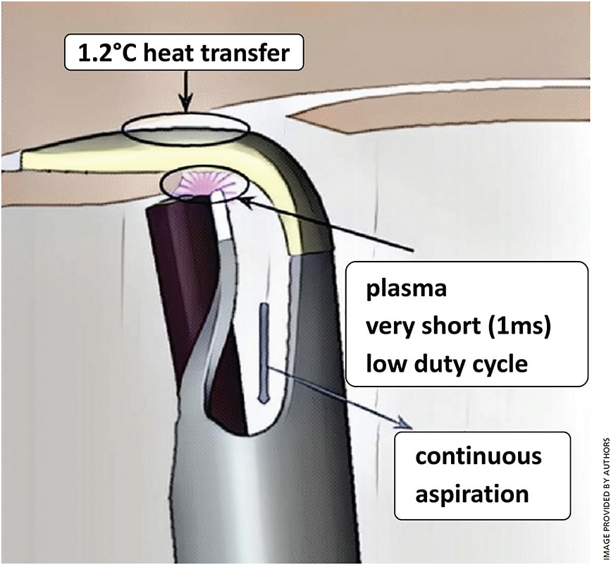 Figure 1. Sketch of the tip of the Trabectome handpiece inserted into the trabecular meshwork. Plasma is generated between the active and return electrode that molecularizes the trabecular meshwork, similar to photodisruptive lasers. Thermal damage as seen in cautery does not occur. An active irrigation and aspiration system removes debris and maintains the chamber.
