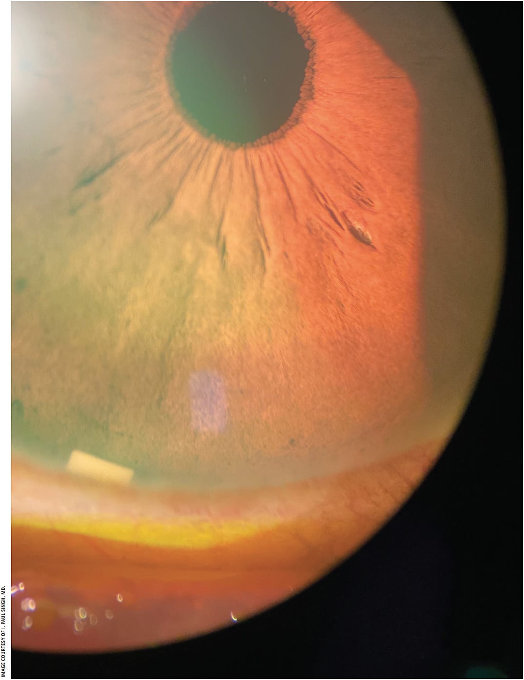 Figure 1. In clinical studies, a single dose of Durysta (shown here postoperatively at the slit lamp) lowered IOP for up to 1 year in 40% of patients and up to 2 years in 28%, with no additional treatment.4