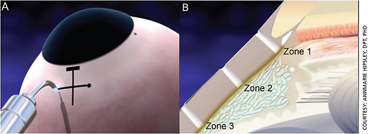 Figure 4. (A) LaserACE surgical technique. (B) LaserACE three critical zones of physiological significance.