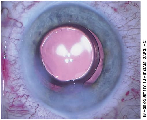 Figure 2. Intraoperative view of the Acrysof IQ Vivity EDOF IOL (Alcon).