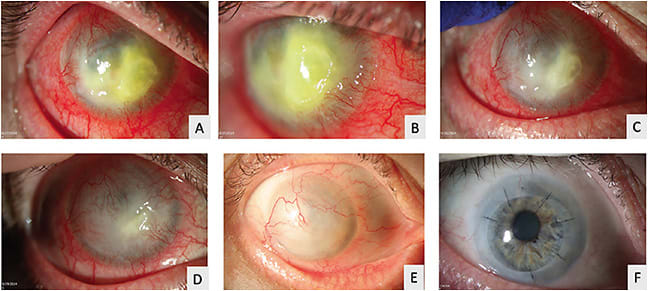 FIGURE 2. A 58-year-old male patient had a diagnosis of fungal keratitis, diagnosed by corneal biopsy on pathology. (A and B) His clinical appearance at presentation showed deep, severe corneal infiltrates, paracentral melting and thinning, with 360° of corneal neovascularization. Riboflavin cross-linking using the Dresden protocol was performed, due to the patient not responding to standard medical treatment. (C and D) At 2 and 4 weeks after the procedure, corneal melting and thinning stopped, the patient’s conjunctiva was more quiet, and the infiltrate was smaller. (E) At 6 weeks after riboflavin CXL, his corneal epithelium healed, and steroid drops were started. (F) A corneal transplant was performed, and the patient’s cornea was clear 2 years after the cornea transplant.