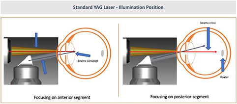 Figure 1. Standard YAG laser tower - on the left, the laser beam and the illumination beam con- verge when focused on the pos- terior capsule. On the right side, the laser beam and illumination beam cross when attempting to focus on a floater in the posterior vitreous, thus not allowing a view of the floater and the relationship between the floater and the retina.