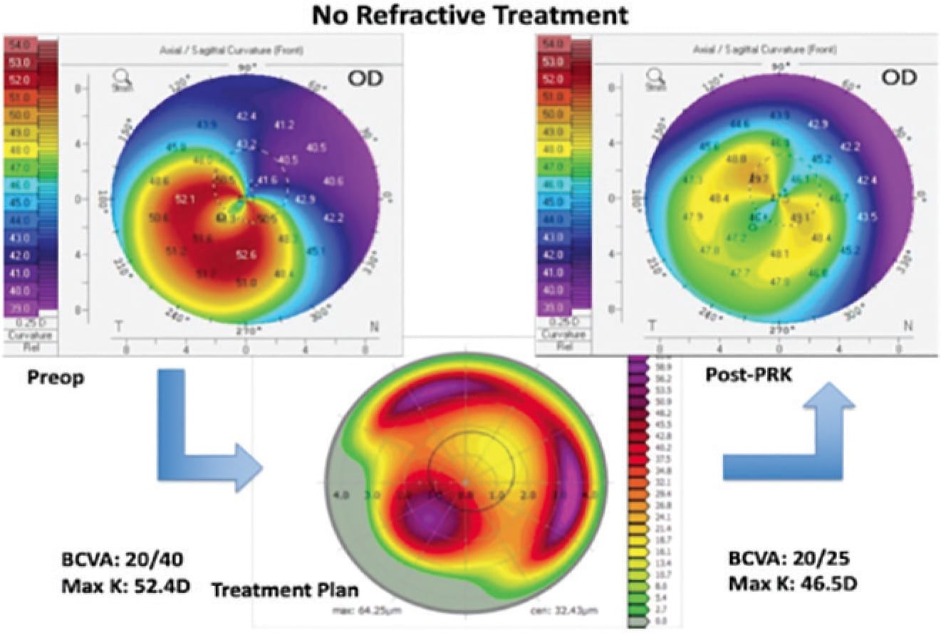 FIGURE 3: Patient with pellucid marginal degeneration showing preoperative topography, topographic treatment plan, and postoperative topography. The patient did well with a toric IOL at the time of cataract surgery.