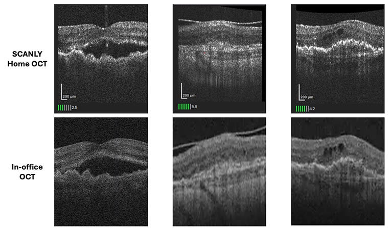 <p><strong>Figure 1. </strong>Side-by-side comparison of images taken with the Scanly home optical coherence tomography (OCT) device and an in-office OCT device demonstrate high&nbsp;concordance in detecting hyporeflective spaces, corresponding to fluid, in patients with neovascular age-related macular degeneration.&nbsp;</p>