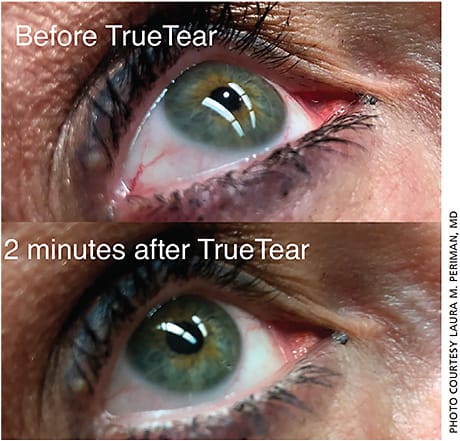 Figure 1. In-office demo of TrueTear. Patient noticed improved tear production and improved conjunctival injection.