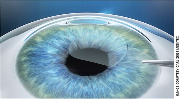 ... and the lenticule is removed through the incision. The removal changes the cornea’s shape but the rest of the superficial cornea remains intact ...