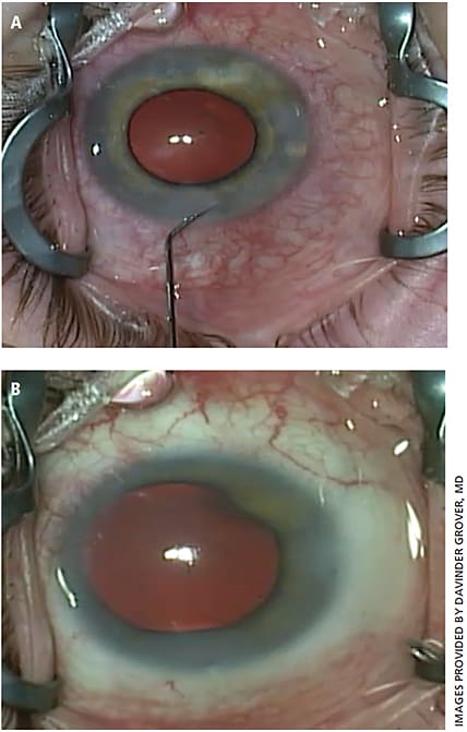 Figure 2. A) A view of the episcleral vessels once a 360° GATT surgery has been performed. B) Diffuse blanching of the episcleral vessels once balanced salt solution (BSS) has been aggressively irrigated into the anterior chamber, forcing and flushing BSS through the downstream collector channels. We have termed this the “episcleral venous fluid wave.”14