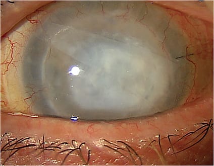 Use of an amniotic membrane under scleral lens in this NK patient.