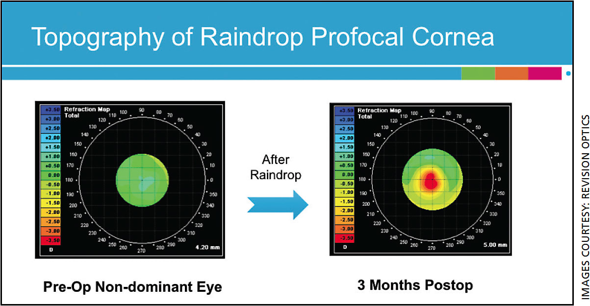 Figure 1. After implantation of the Raindrop Inlay, the cornea steepens in the center to provide a 3+ diopter improvement in near.
