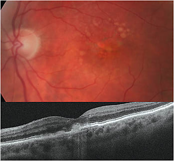 89-year-old female with wet AMD OS. CNV was observed via SD-OCT.