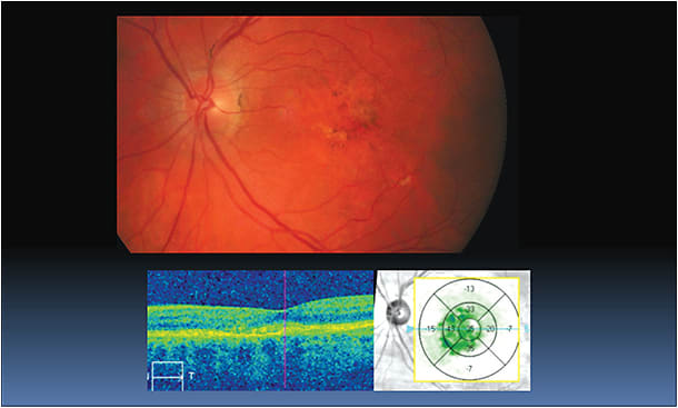 Figure 3a and 3b: Three-month follow up after bevacizumab (Avastin, Genentech) treatment. Retinal topography shows thinning; SDOCT shows hyper reflective area within the RPE, with no associated fluid. Dilated fundus shows pigmentary changes and decrease of retinal thickening, without signs of hemorrhages.