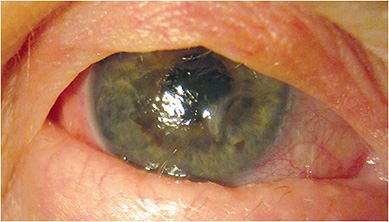 A bandage lens on a cicatricial pemphigoid patient. Use code 92071. Photo courtesy of Greg DeNaeyer, OD, FAAO.