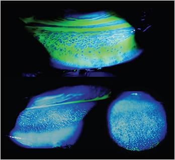 SAC signs: Chemosis and lower tarsal follicular reaction Images courtesy of Dr. Gregory W. DeNaeyer.