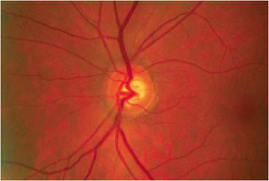 Glaucoma&#x27;s characteristic and preferential neuroretinal rim loss can be observed during the glaucoma consultation.Image courtesy of Austin Lifferth, OD, FAAO