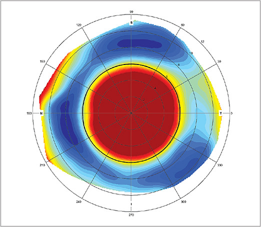 Figure 3: Scleral asymmetry