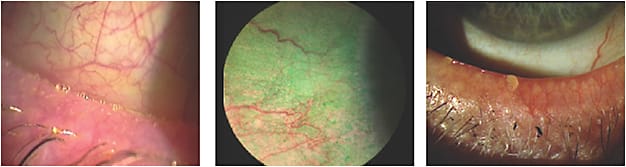 Figure 1. Signs of dry eye at the slit lamp: (A) frothing, (B) vital dye staining, (C) clogged meibomian glands.