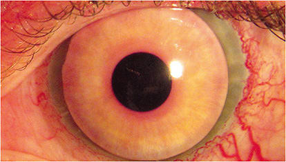 Figure 2. Iris diameter is important to ensure coverage. For another patient, the iris portion was slightly small. Image courtesy of Dr. Gregory W. DeNaeyer.