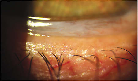 Conjunctivochalasis can cause tears to spill out of the eye.
Courtesy of Vance Thompson Vision