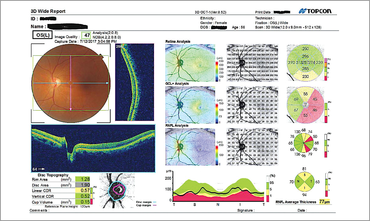 Wide-field OCT scan of patient at Dr. Bazan&#8217;s practice revealed pallor on the optic nerve head, a sign of optic neuritis.&#xA;Courtesy of Justin Bazan O.D.