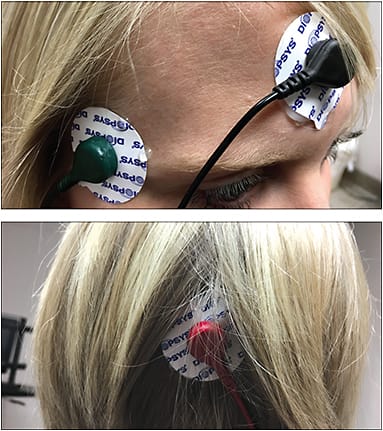 Electrode placement for VEP, forehead, temple and back of the scalp.
Courtesy of Nathan Lighthizer, O.D., F.A.A.O.