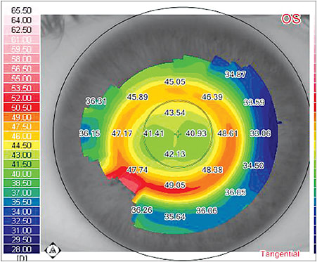 Treatment zone of a toric ortho-k lens. The patient started with 2.50D of astigmatism and still has 0.75D residual astigmatism, but is not bothered by her vision.