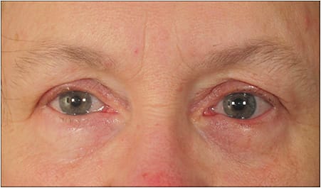 Allergic conjunctivitis is a common cause of epiphora. Diagnosis is via elimination.
Courtesy of Vance Thompson Vision