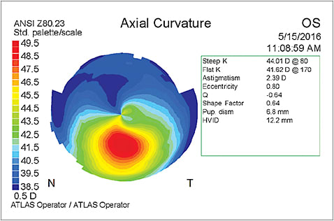 Note the inferior steepening on topography.