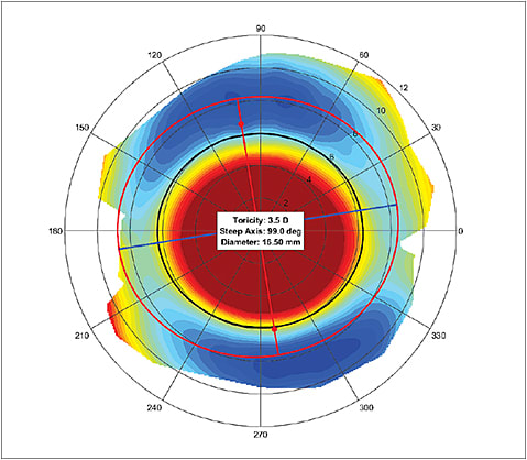 Figure 2: With-the-rule scleral toricity