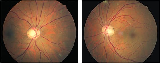 Dilated fundus exam revealed cotton wool spots OU, exudates OD and retinal hemorrhages OU. Communication with the patient’s other doctors was necessary for the best patient care.
Courtesy of Diana Shechtman, O.D.