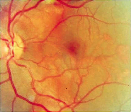 Figure 2. PCV in a 38-year-old Black female. Note the visible orange/red polyps. Image courtesy of Dr. Sherrol Reynolds