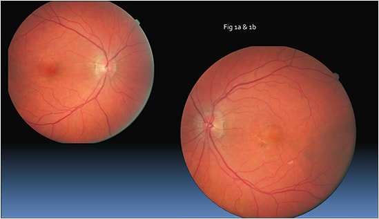 Figure 1a and 1b: Dilated fundus exam showing pigmentary changes and drusen OU.