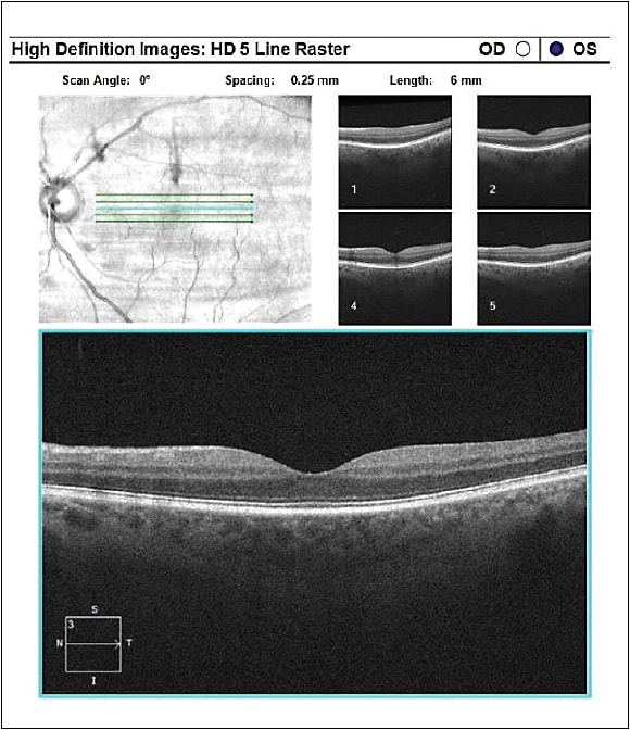 Post: Upper left-hand image now shows depleted floater, and the upper right-hand image shows no evidence of a shadow.Courtesy of Dr. I. Paul Singh