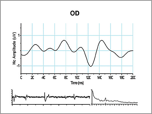Abnormal PERG is high rate of RNFL thinning.
Courtesy of Diopsys.