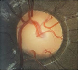 Stereoscopic view of a glaucomatous optic nerve head.