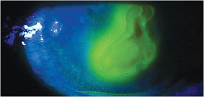 HSV stromal keratitis with a secondary infectious corneal ulcer. Topical steroid treatment in this contact lens patient with no subsequent antibiotic coverage led to this infectious ulcer.
Courtesy of Josh Johnston, O.D., F.A.A,O.