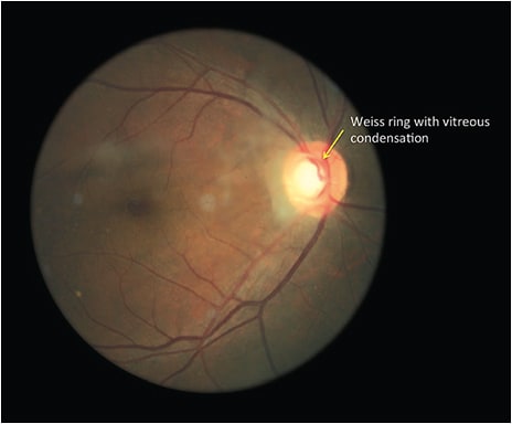 Note the Weiss ring via dilated exam in a 66 year-old.